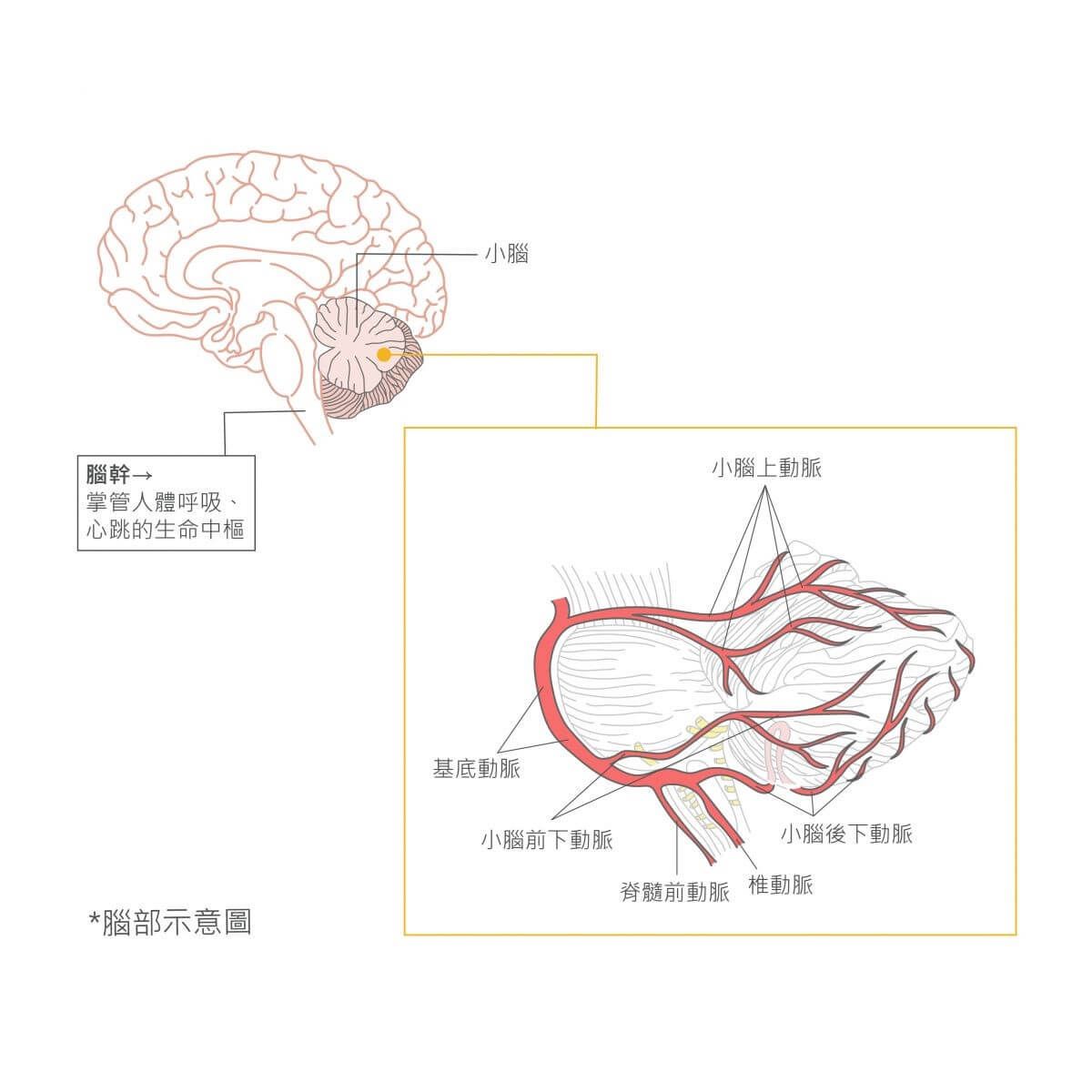 小腦梗塞型中風 小腦梗塞型中風