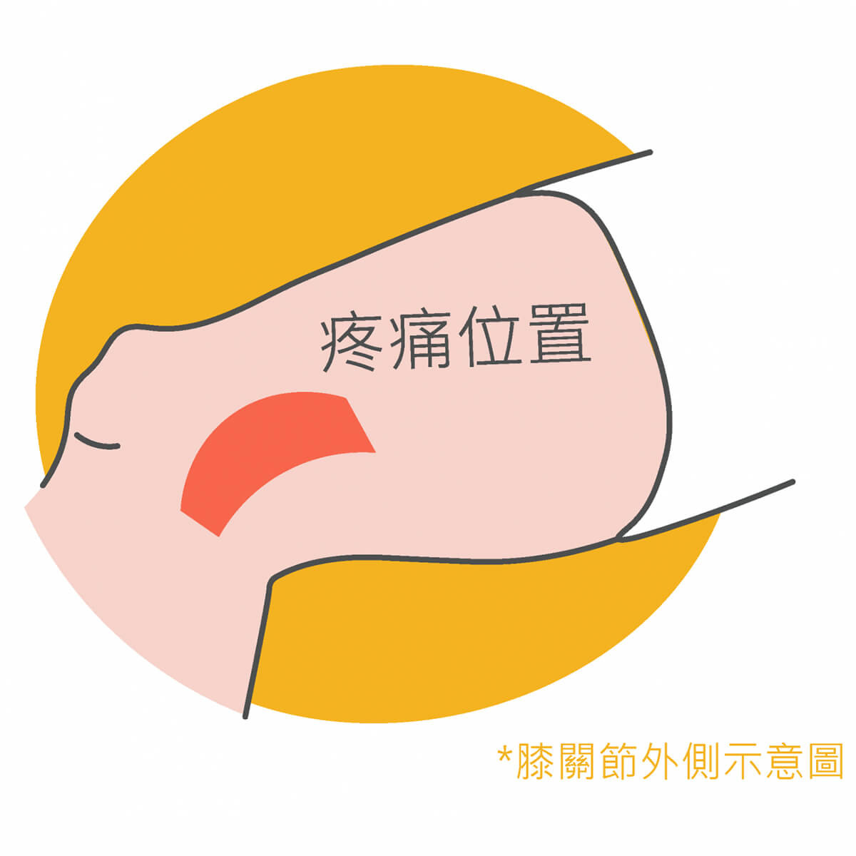 髂脛束症候群 髂脛束症候群