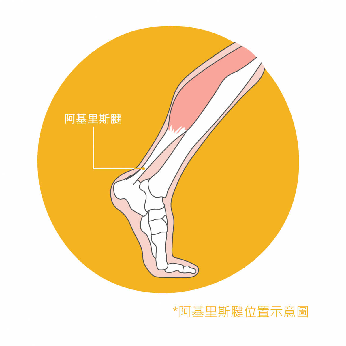 阿基里斯肌腱炎 阿基里斯肌腱炎