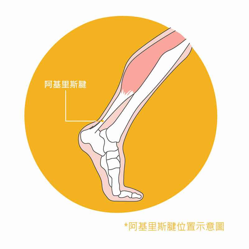 阿基里斯肌腱炎